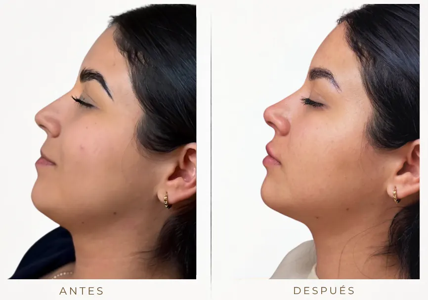 Antes y después: armonización facial (labios, mentón, rinomodelación, ojera)