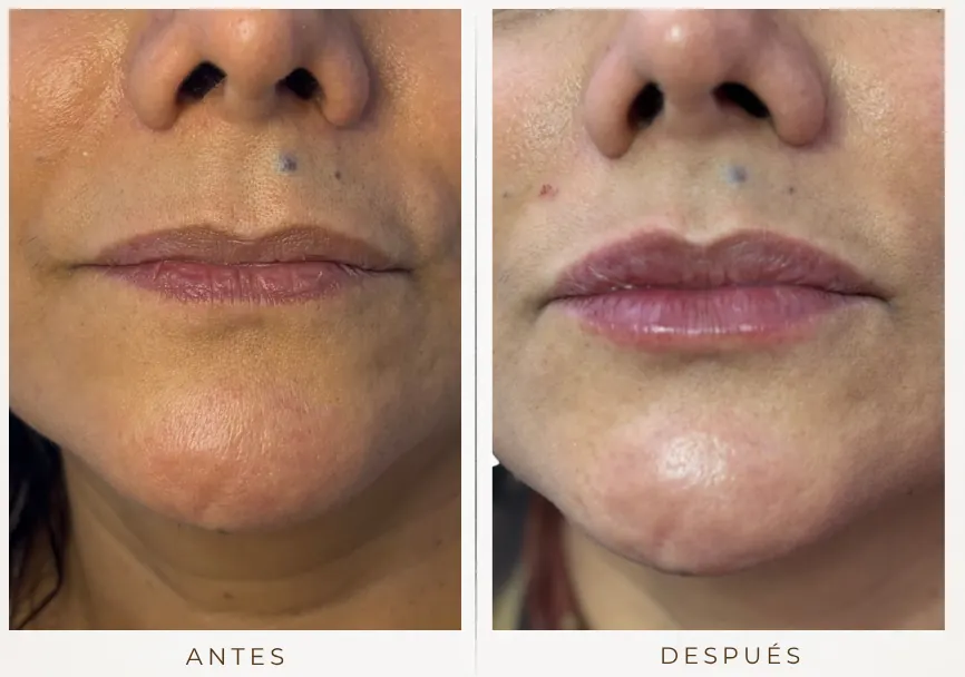 Antes y después: Diseño de labios