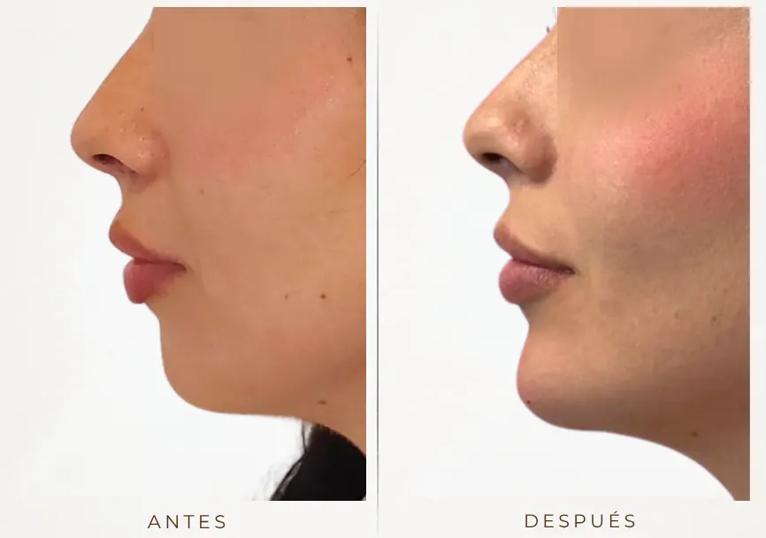 Antes y después: Mentón