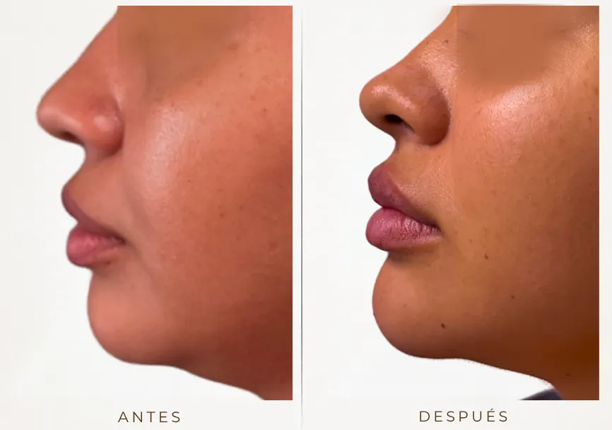 Antes y después: Armonización de perfil (rinomodelación, labios, mentón)