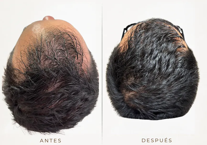 Antes y después: Terapia capilar regenerativa (factores de crecimiento y exosomas)