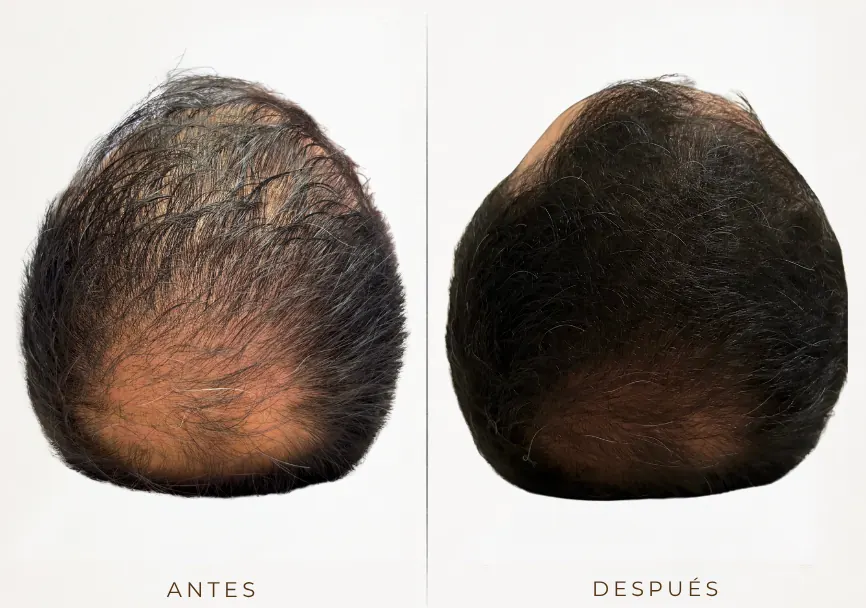Antes y después: Terapia capilar regenerativa (factores de crecimiento y exosomas)