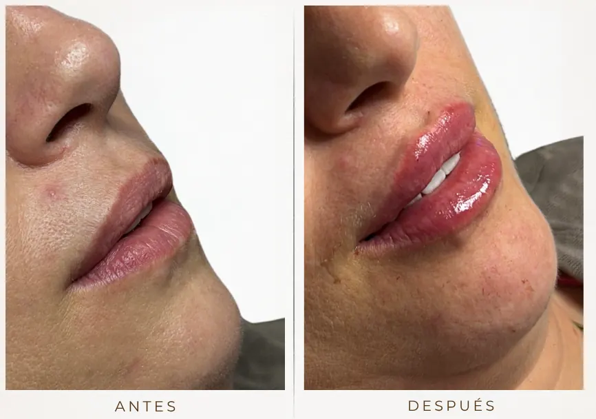 Antes y después: Diseño de labios