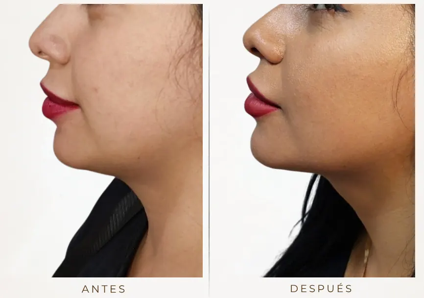 Antes y después: Lipopapada y bichectomía enzimática