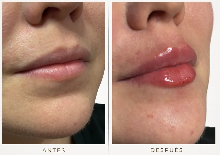 Antes y después: Diseño de labios