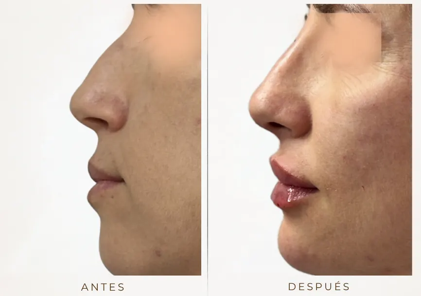 Antes y después: Armonización facial (labios, rinomodelación, mentón, pómulos)
