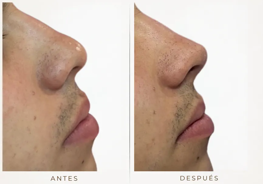 Antes y después: Rinomodelación