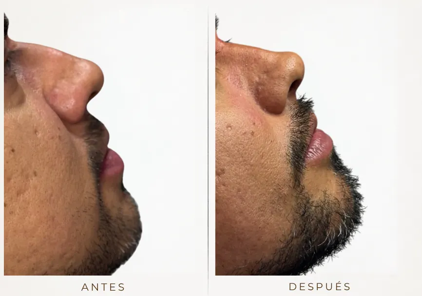 Antes y después: Rinomodelación y mentón